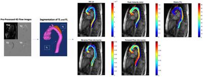 Baseline 4D Flow-Derived in vivo Hemodynamic Parameters Stratify Descending Aortic Dissection Patients With Enlarging Aortas